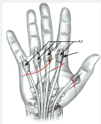 Болит и щелкает большой палец на руке. Стенозирующий лигаментит. Болезнь Нотта. Кольцевидная связка 1 пальца кисти. Кольцевидная связка а1 первого пальца. Кольцевидная связка 1 пальца анатомия.